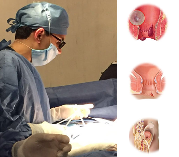 Cirugía de Colon y Recto